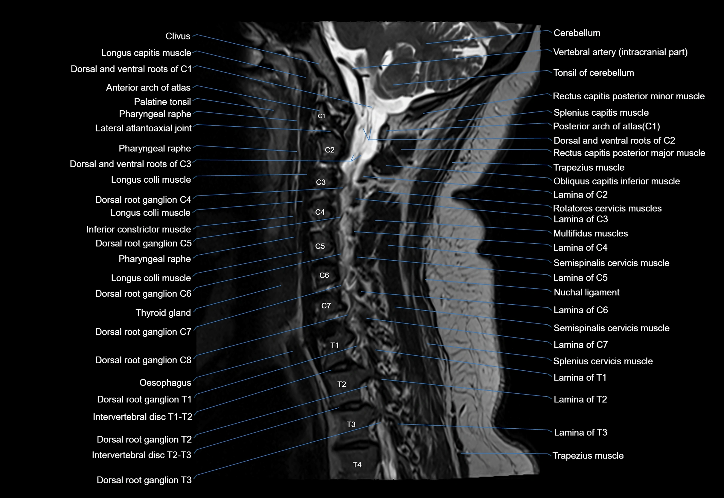 cervical spine cross sectional MRI anatomy 3T MRI  sagittal image-img-00001-00021.webp